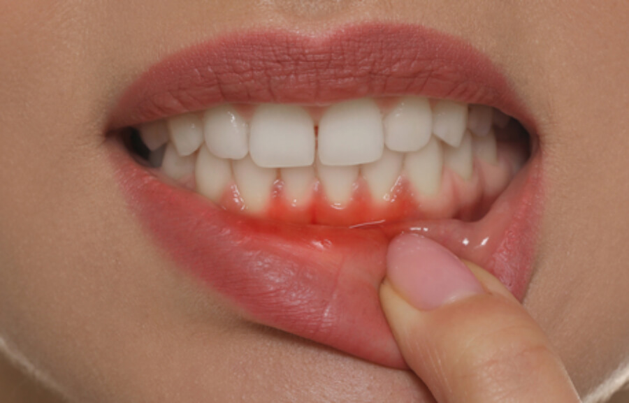 Simptome asociate gingiilor inflamate