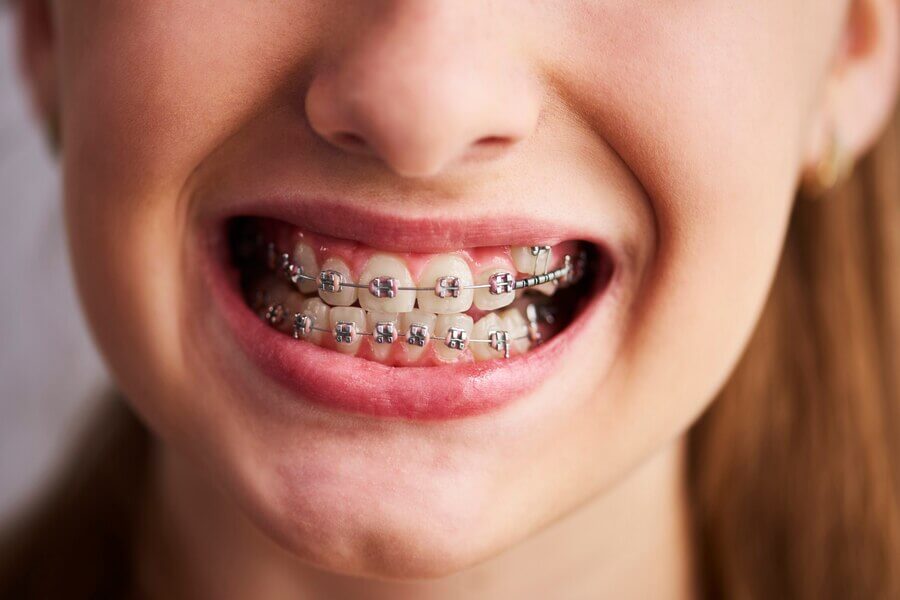 aparat dentar copii 2