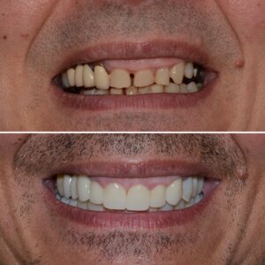 Dinti perfecti dupa reabilitare INO Dental arcada superioara estetica
