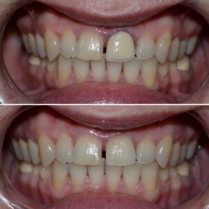 Dinte incisiv frontal INO Dental coroana full zirconiu estetica