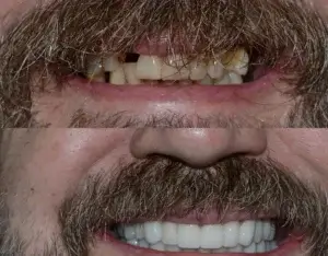 Rezultat tratament dentar INO Dental