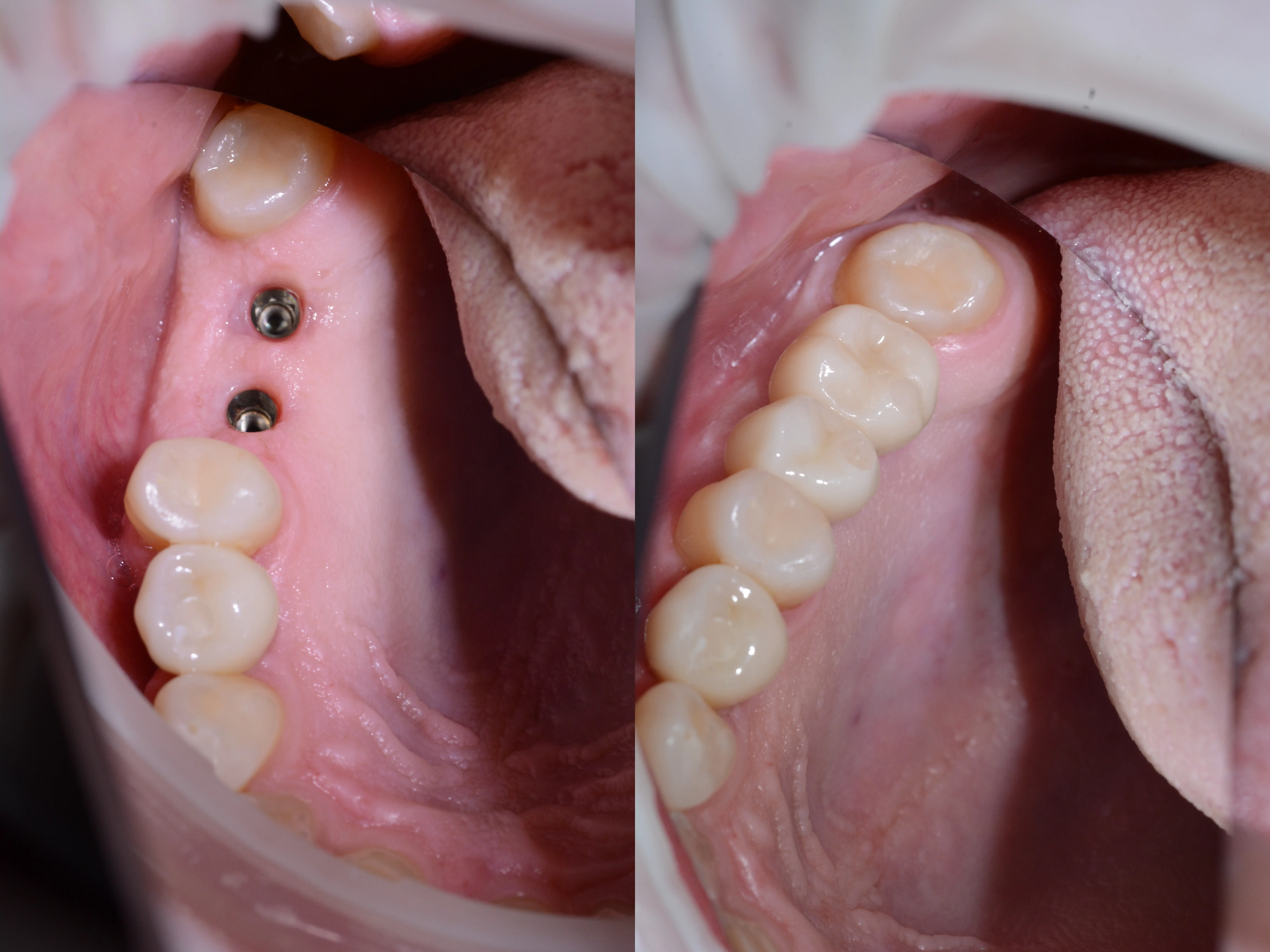 Coroane zirconiu integral INO Dental reabilitare estetica functionala