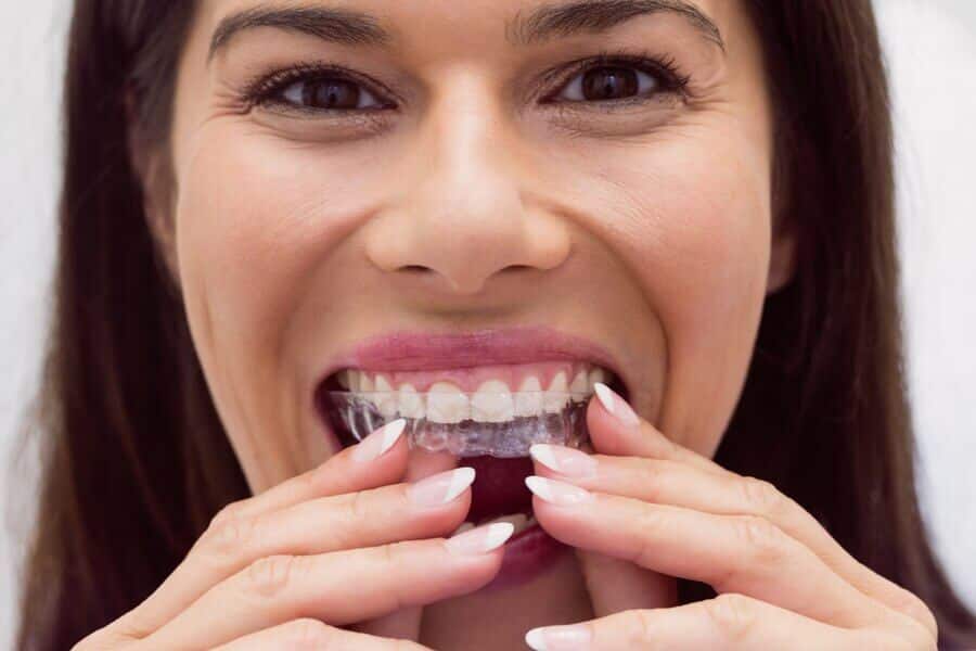 Aparat dentar Spark 1