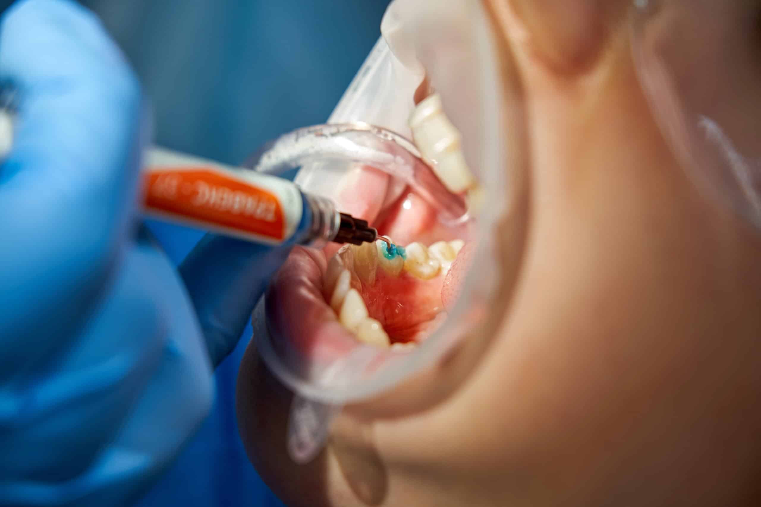 Încrustațiile dentare (inlay/onlay) – Restaurări cu precizie de laborator