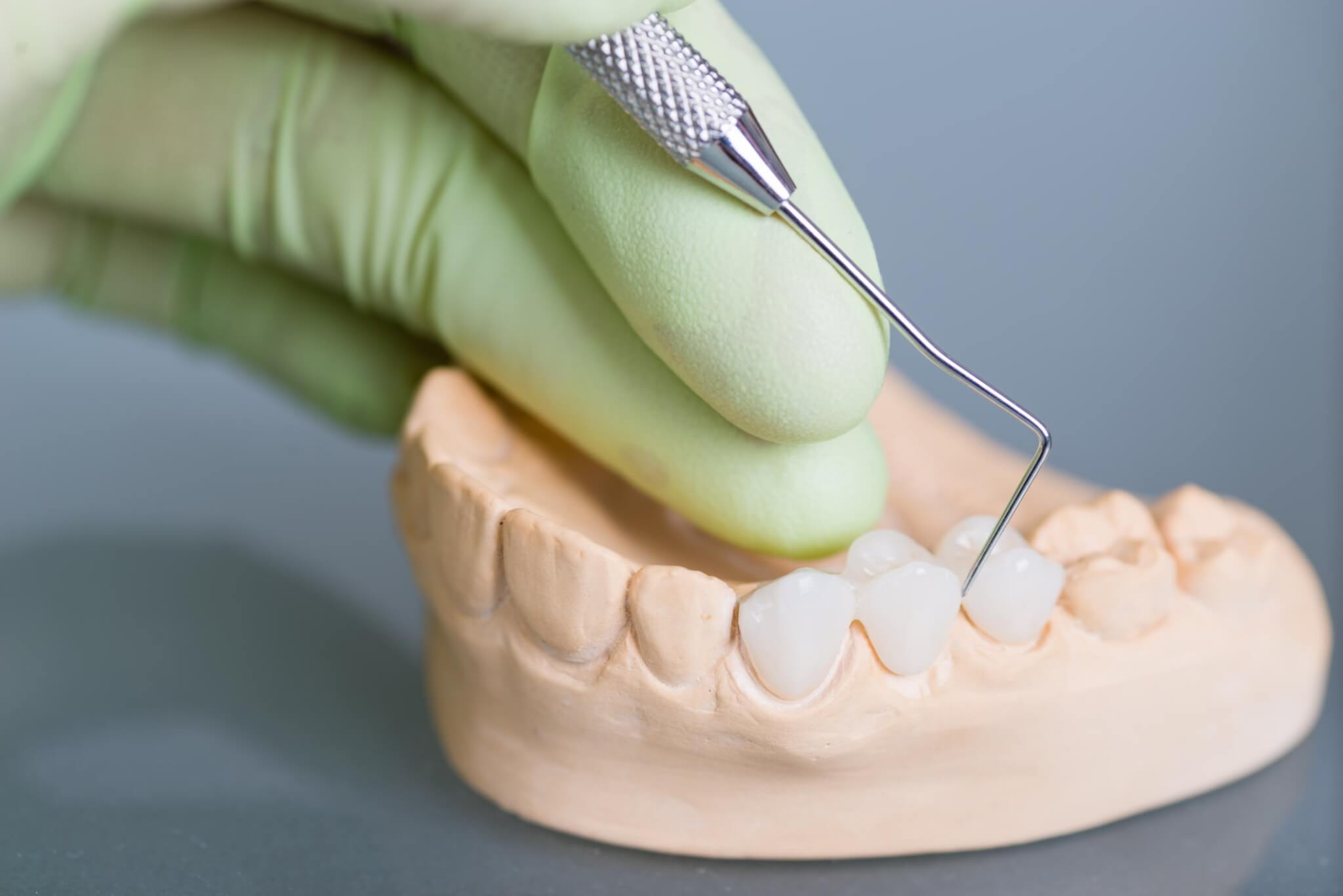 Puntea dentară – Soluția fixă pentru dinți lipsă