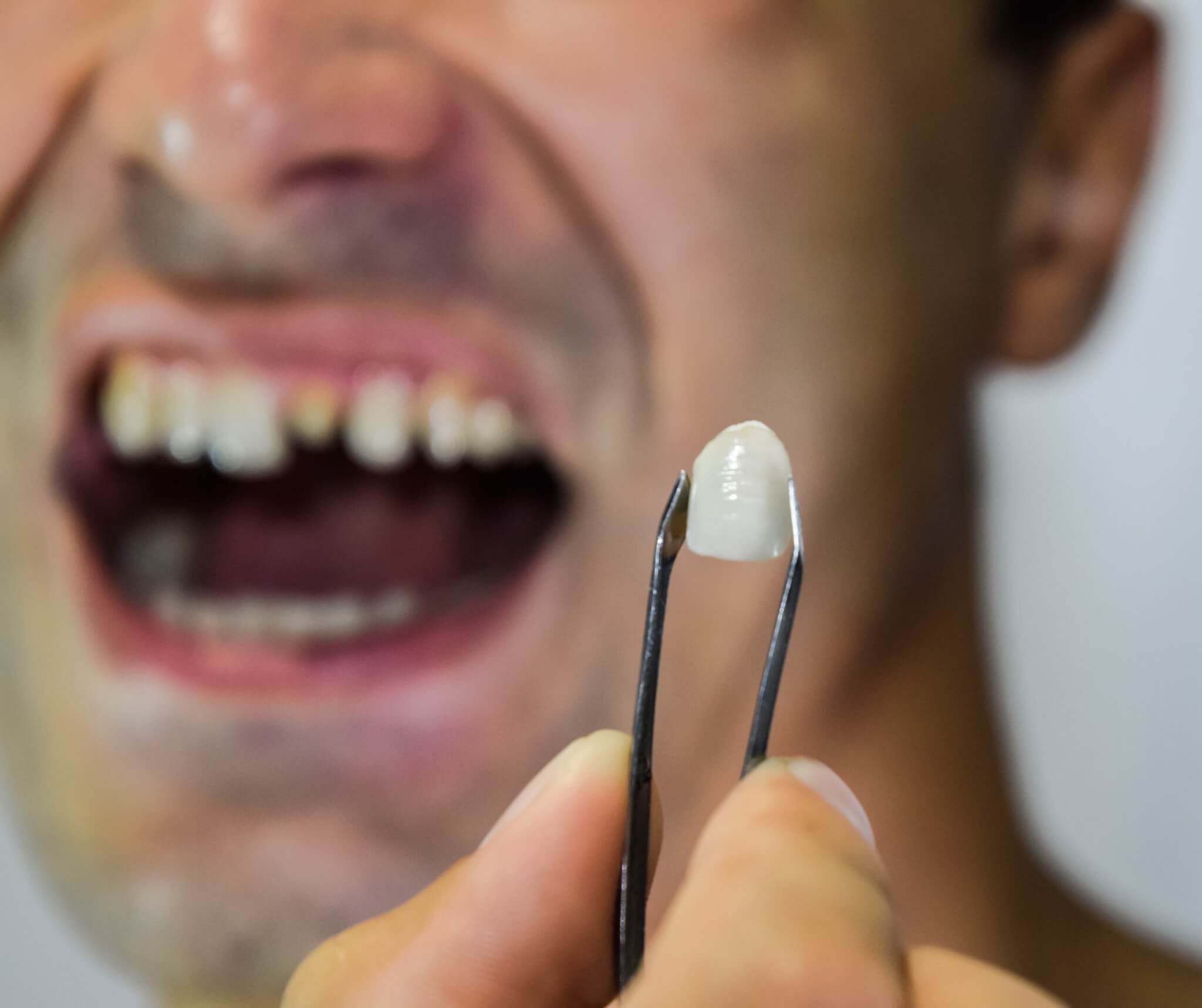 Coroanele dentare estetice – zirconiu, ceramică, compozit