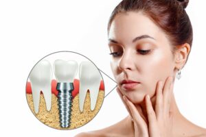 când nu se poate face implant dentar