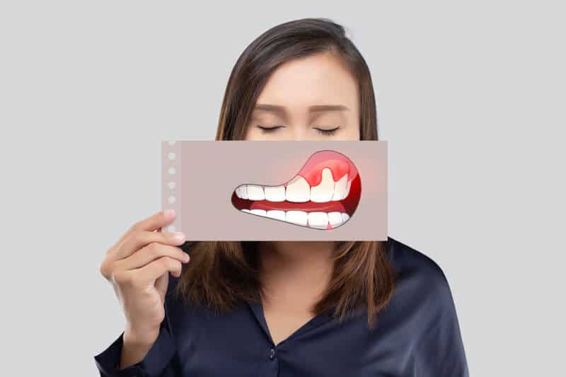 gingii inflamate tratament