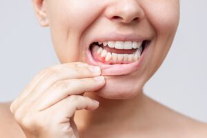 Gingie albă după extracție dentară – proces normal de vindecare