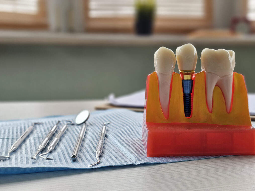 Implant dentar Straumann inserat cu precizie digitală
