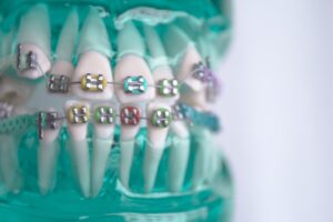 Tratament ortodontic cu elastice aparat dentar la INO Dental București
